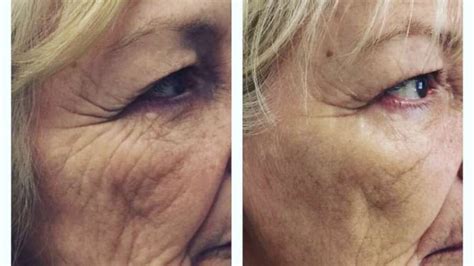 Wrinkle Reduction Vivo Medspa And Wellness Institute