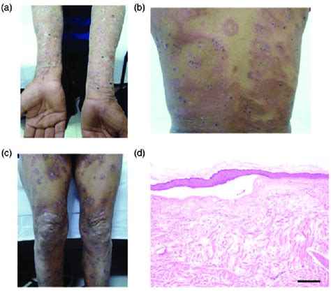 The Clinical Features Of Bullous Pemphigoid On The Forearms Trunk And