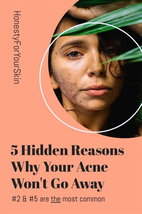Acne Wont Go Away Help These Are The 5 Hidden Reasons Why Acne