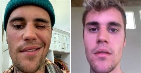 Justin Bieber Says He Is Struggling To Eat Amid Facial Paralysis Caused