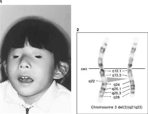 Hypergonadotropic Hypogonadism In A 3 Year Old Girl With Blepharophimosis Ptosis And