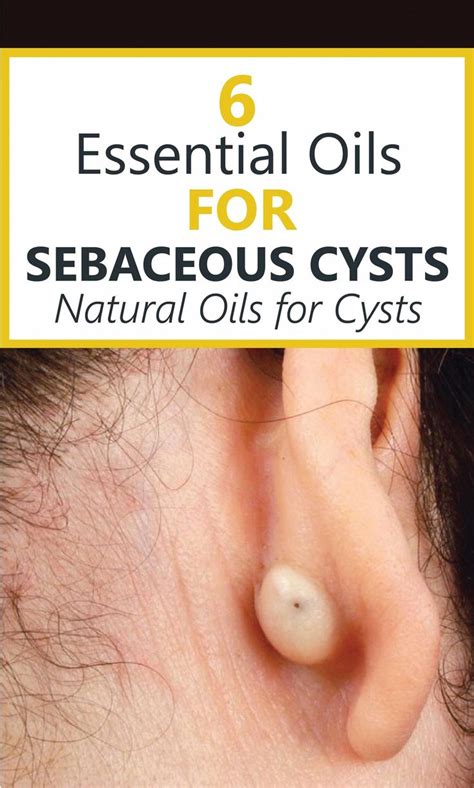 It is skin, not a case. Do You have A Lump On your Neck, Back, Or Behind Your Ear ...