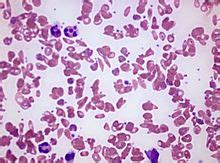 Die betroffenen bilden einen abnormen roten blutfarbstoff (hämoglobin). Sichelzellenanämie - Wikipedia