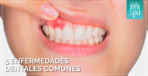 Las 5 Enfermedades Dentales MÁs Comunes 1485 Dental Spa