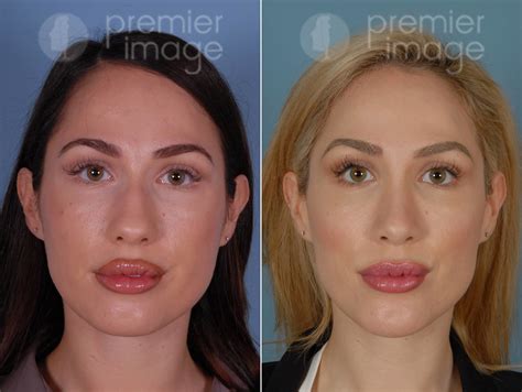 Chin Augmentation Rhinoplasty Before And After Photos Sandy Springs