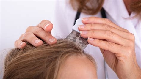 Diagnosing Scalp Psoriasis What Doctors Look For