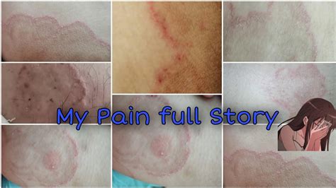 Ringworm Kharishtinea Cruris How I Recover After 6 Month Complete