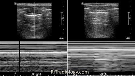 Rit Radiology Pneumothorax On Ultrasound