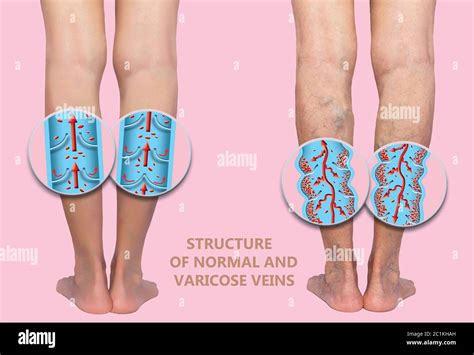 Varicose Veins On A Female Senior Legs The Structure Of Normal And