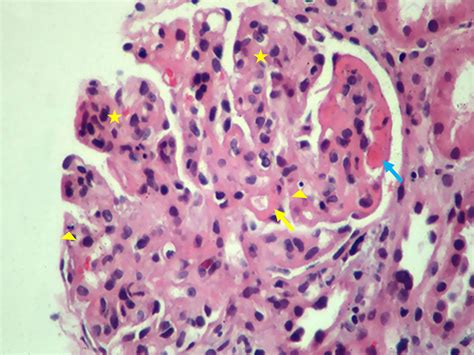 Educational Case Lupus Nephritis As An Example Of Immune Complex