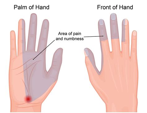 The carpal tunnel is a narrow passageway found on the anterior portion of the wrist. Carpal Tunnel Syndrome - My Family Physio