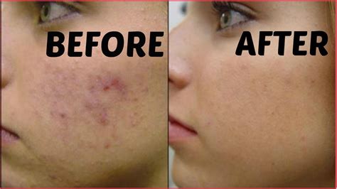 How To Remove Dark Spots Acne Scars Black Spots In Just 3 Days