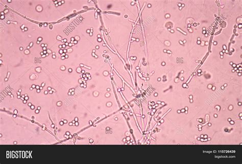 Branching Budding Yeast Cells With Pseudohyphae In Urine Fine With