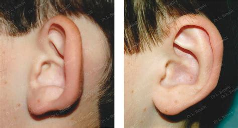 Otoplasty Surgery Of The Ears Doctor Louis Benelli In Paris