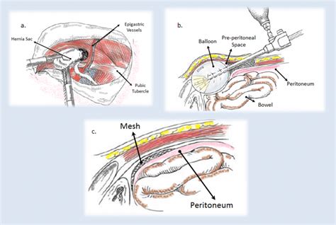 Laparoscopic Inguinal Hernia Anatomy