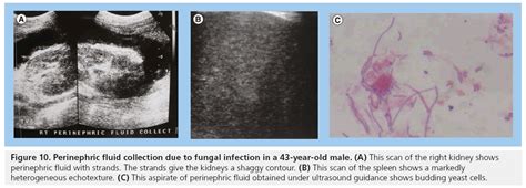 Abdominal Ultrasound Findings In Hiv And Tuberculosis
