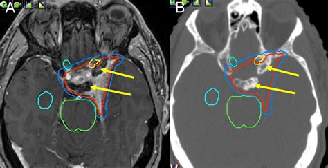 Estro Acrop Guideline For Target Volume Delineation Of Skull Base