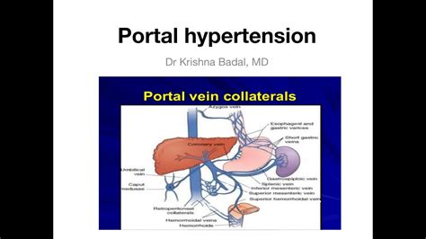 Portal Hypertension Collaterals