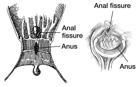 Anal Fissures Learn About Nifedipine Ointment Other Treatments