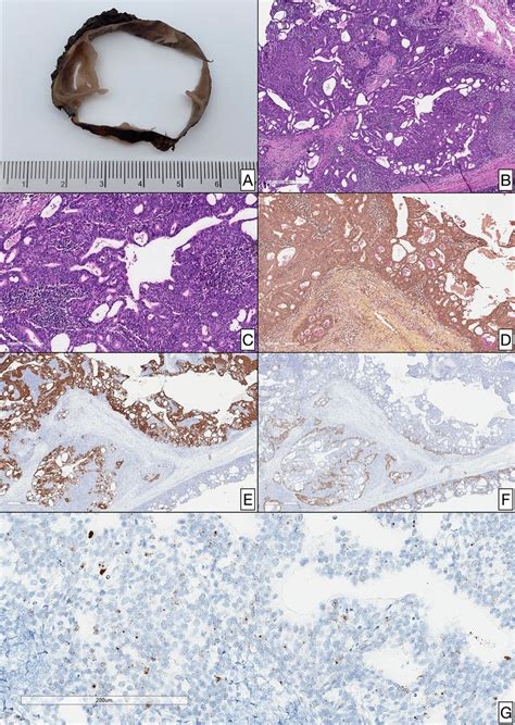 Gross And Histologicimmunophenotypic Findings In The Metastatic Lymph
