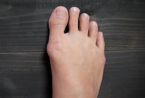 Bunions Causes Symptoms And Medical Treatment