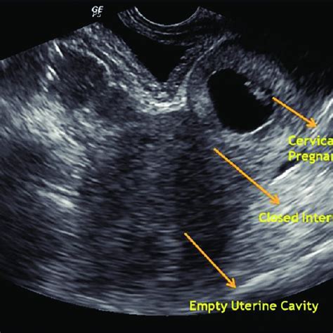 Ovarian Ectopic Pregnancy Transvaginal Ultrasound Showing A