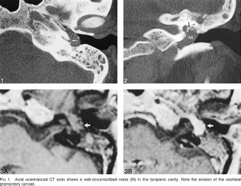 Figure 1 From Jacobsons Nerve Schwannoma Presenting As Middle Ear Mass