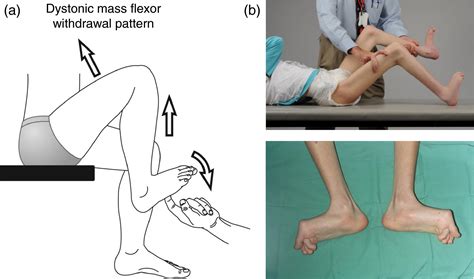 Symptomatic Hallux Valgus And Dorsal Bunion In Adolescents With