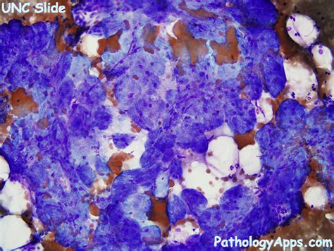 Sialadenosis Salivary Gland Cytology