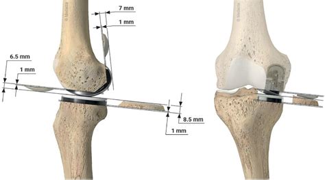 Kinematic Alignment Technique For Unicompartmental Knee Arthroplasty