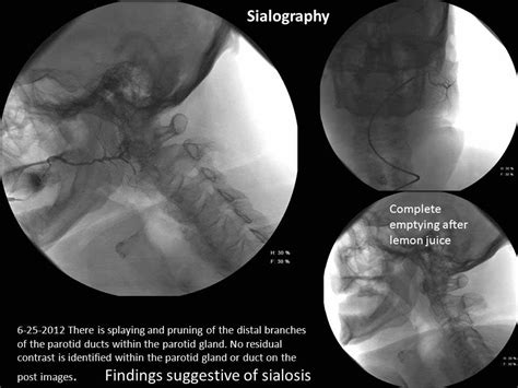 Sialosis Or Sialadenosis Case Example Of Surgical Treatment Iowa Head