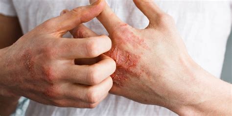 Eczema Treatment In Dubai A Natural Cure Find Your Root Cause
