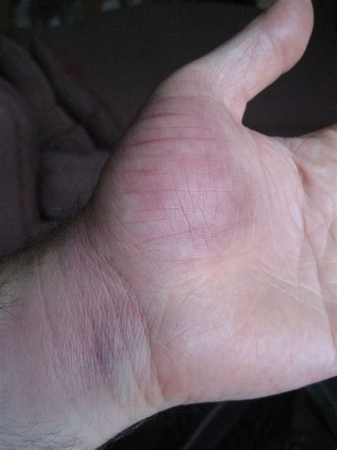 Just Slammed My Hand On The Handlebar Broken Blood Ves Flickr