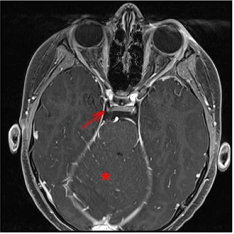 Figure 3 From Third Cranial Nerve Palsy Clinical And Radiological
