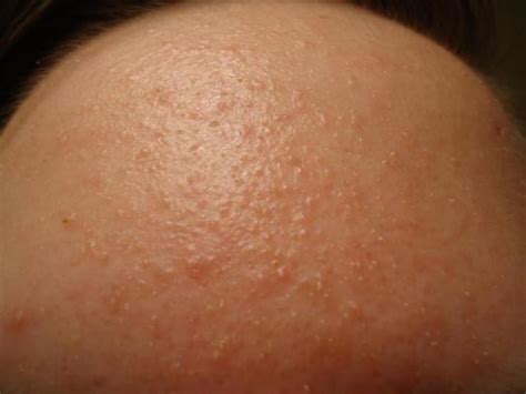 Strange Acnerash On Forehead General Acne Discussion