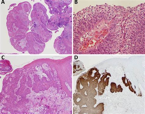 Papillary Squamous Cell Carcinoma Of The Trachea Associated With Human