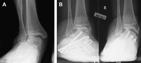 Management Of Varus Or Valgus Ankle Deformity With Ankle Replacement