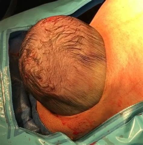 Baby S Head Pops Out Of Mother S Stomach During C Section Daily Mail
