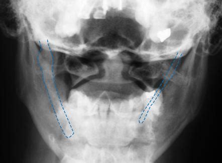 Stylohyoid Ligament Radiology Reference Article Radiopaedia Org