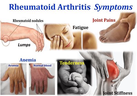 Symptoms Of Rheumatoid Arthritis Jointpainrelief En Artrosis My Xxx
