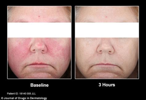 New Treatment Could Help Rosacea Sufferers By Reducing Facial Redness