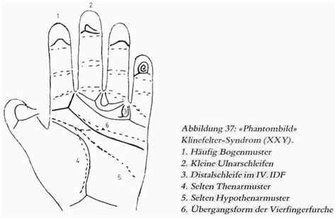 Hand Chart For Klinefelter Syndrome A Rodewald And H Zankl 1981