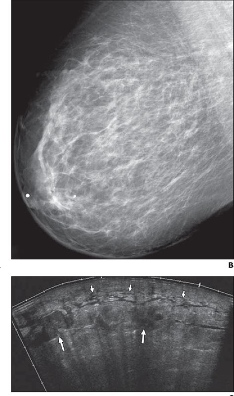 Figure 4—67 From Mri Features Of Inflammatory Breast Cancer Semantic