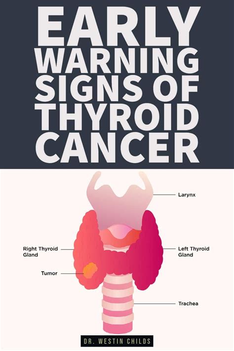 Thyroid Cancer Symptoms Early Warning Signs Artofit