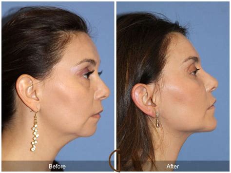Facial Fat Grafting Before And After Photos Patient 26 Dr Kevin Sadati