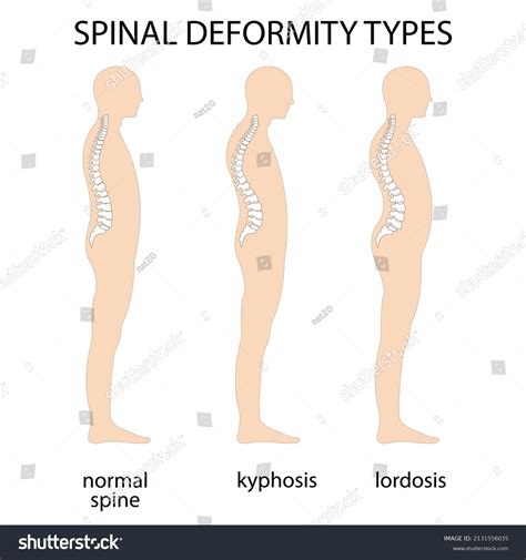 Spine Deformity Vector Illustration Kyphosis Lordosis Stock Vector