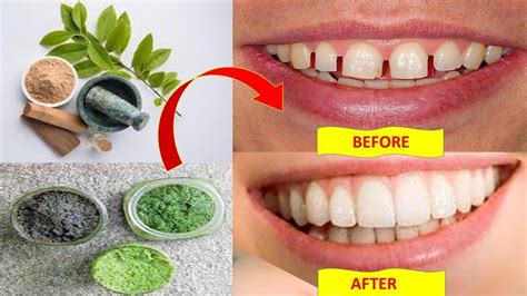 While it is normal for baby teeth to fall out and make way for. How to fix gap between teeth naturally at home without ...