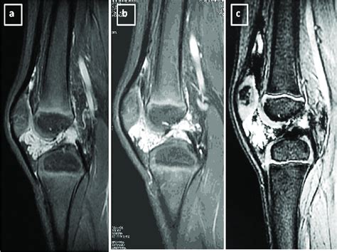 Sagittal MRI Images Of The Right Knee A Proton Density Download Scientific Diagram