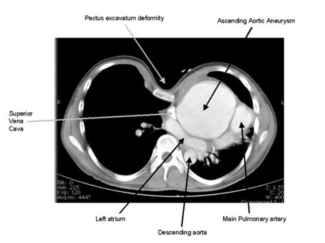 Ct Scan Ct Scan Demonstrating A 10 Cm Ascending Aortic Aneurysm The