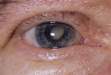 Signs and symptoms of cataracts include: Cataract in the eye - Stock Image - M155/0505 - Science ...